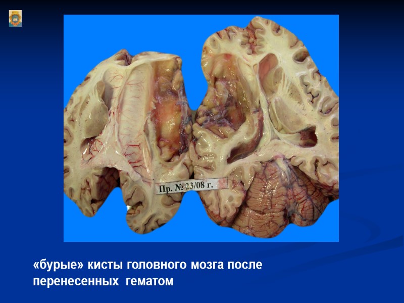 «бурые» кисты головного мозга после перенесенных  гематом